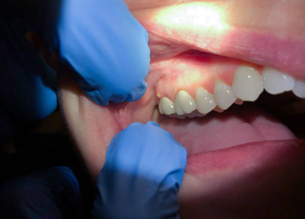 Best Emergency Tooth Extraction in Sandwich, IL